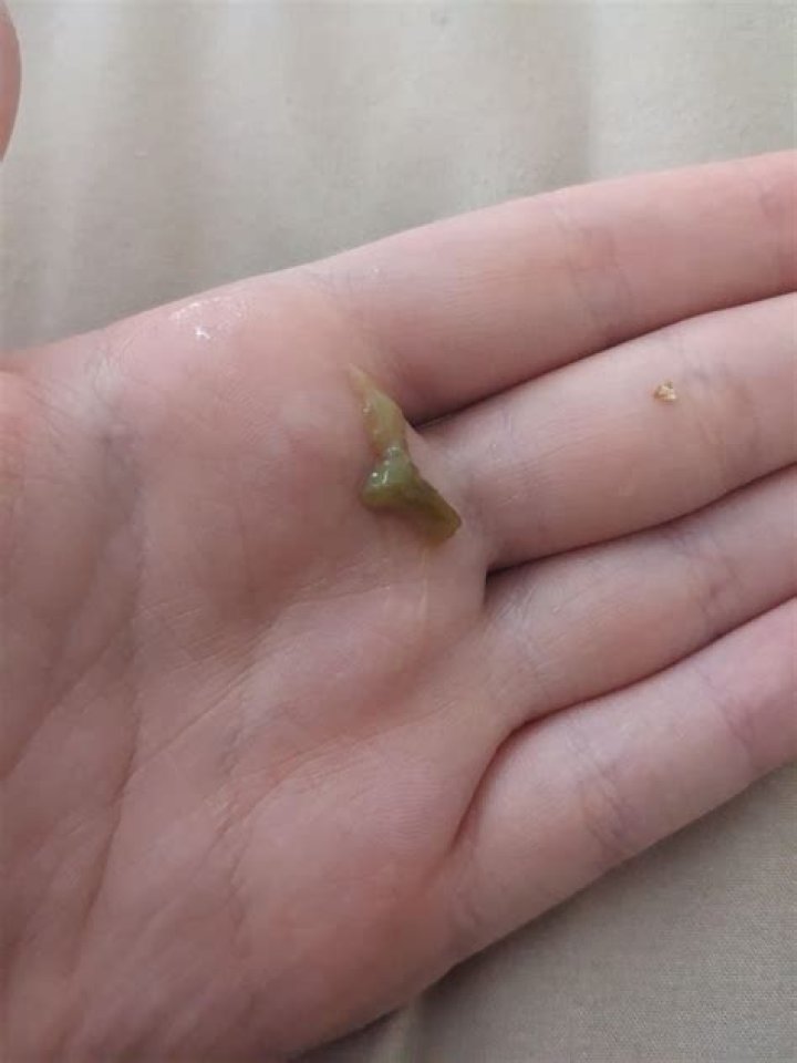 What are the stinky balls I cough up?