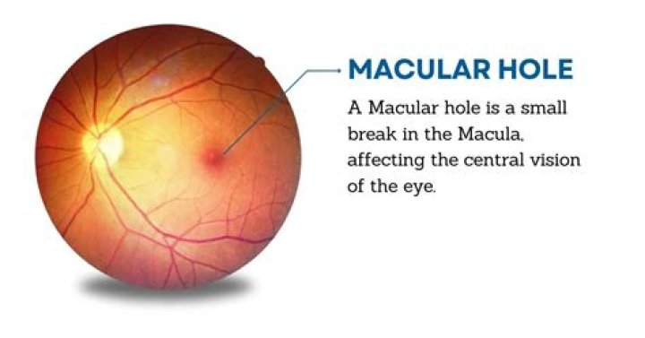 What is the macula of ear?